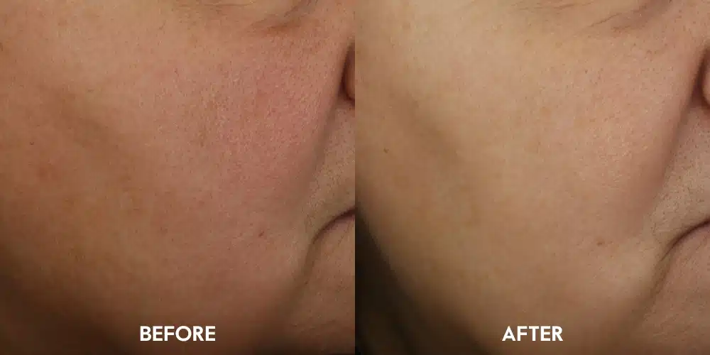 Plumping Hyaluronic Serum boosts skin hydration by 44%¹