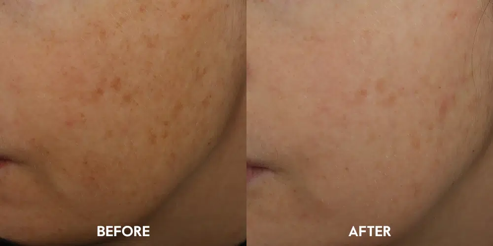 Overnight Glow Treatment reduces signs of premature ageing caused by sun damage by 33%²