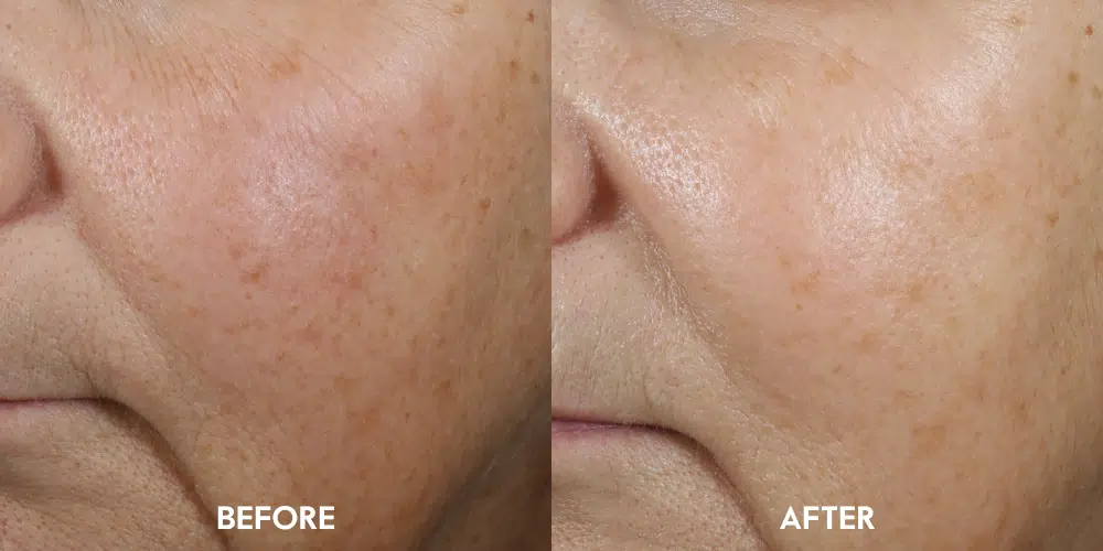 Renewal A Serum increases the appearance of skin firmness by 26%¹